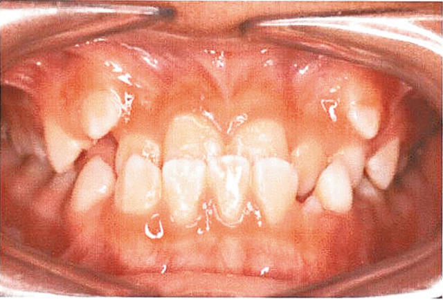 一般患者在青春期或更早前会发现倒及牙问题。