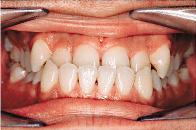 矫齿治疗前上门牙较下门牙向内倾。