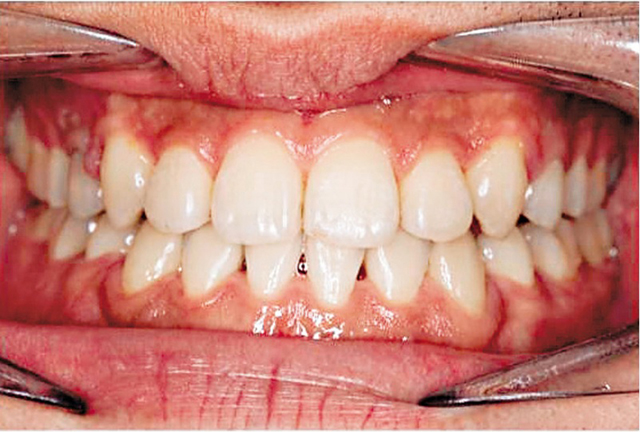 经过治疗后可看见整排上门牙。 