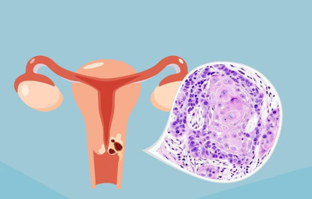 宫颈癌没有早期异常症状，因此建议所有女性定期接受筛选检查。