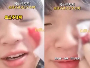 20230613CPKK14c_CHINA_MAN_PIMPLES