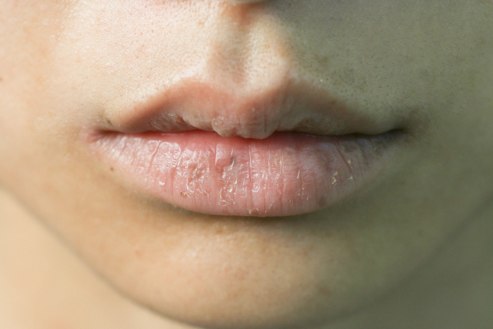 Chapped,,Or,Cracked,,Dry,Lips,That,Have,Lost,Moisture,Because