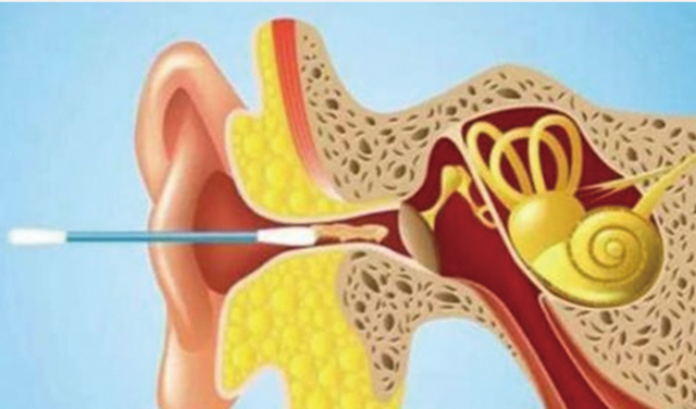 耵聍不仅可以保护外耳道上皮，还可以阻挡灰尘、小飞虫等进入外耳道，保护鼓膜。