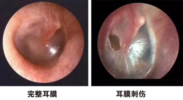 时常掏耳朵不小心刺伤耳膜，会影响耳朵听力。