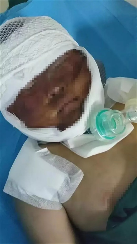 最美5朵金花剃头捐肤救外甥 2