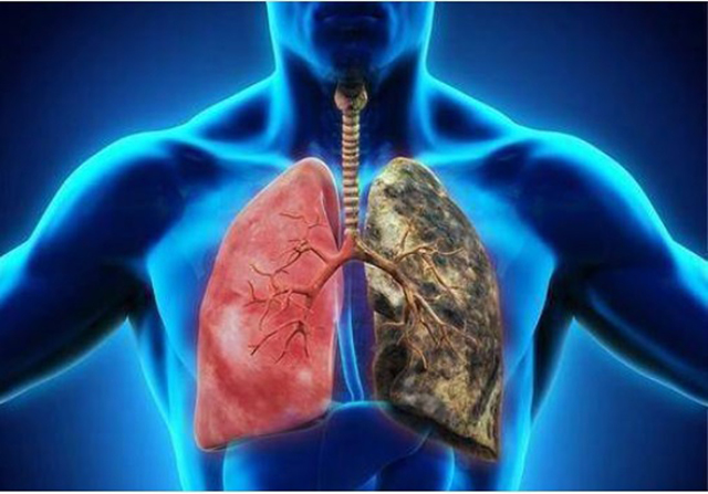 肺部疾病往往被误认为是感冒，因为这些症状类似于感冒，很容易混淆。如果治疗延误，肺炎会逐渐发生，严重的肺炎会导致肺癌。