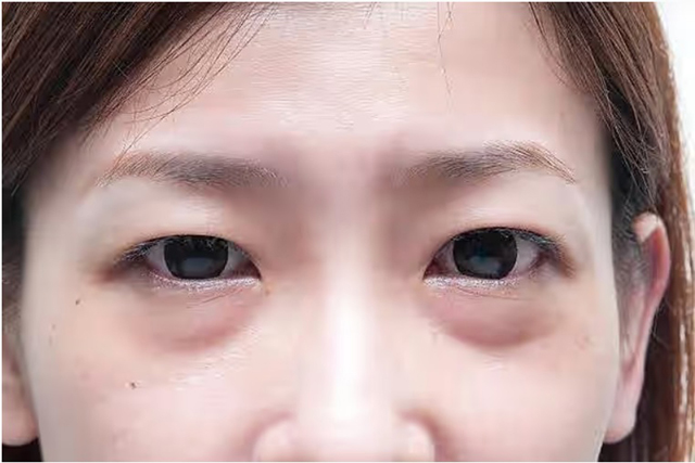 发现眼球突出或浮肿可能患有甲亢引起和肾脏疾病。