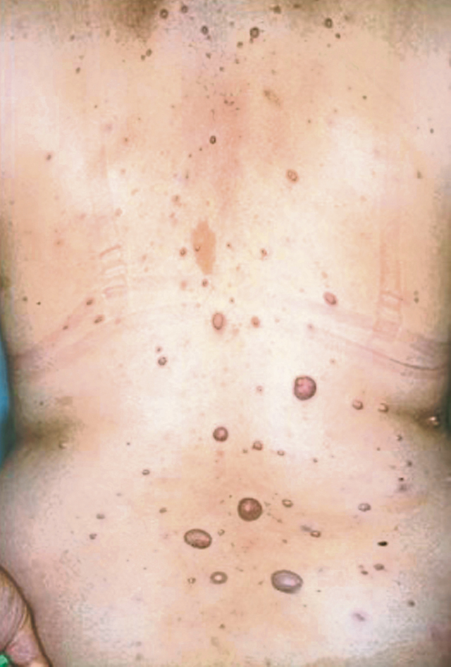 这张照片显示患有1型神经纤维瘤病的人背部有多个神经纤维瘤（隆起的褐色肿块）和牛奶咖啡斑（平坦的褐色斑点）。 