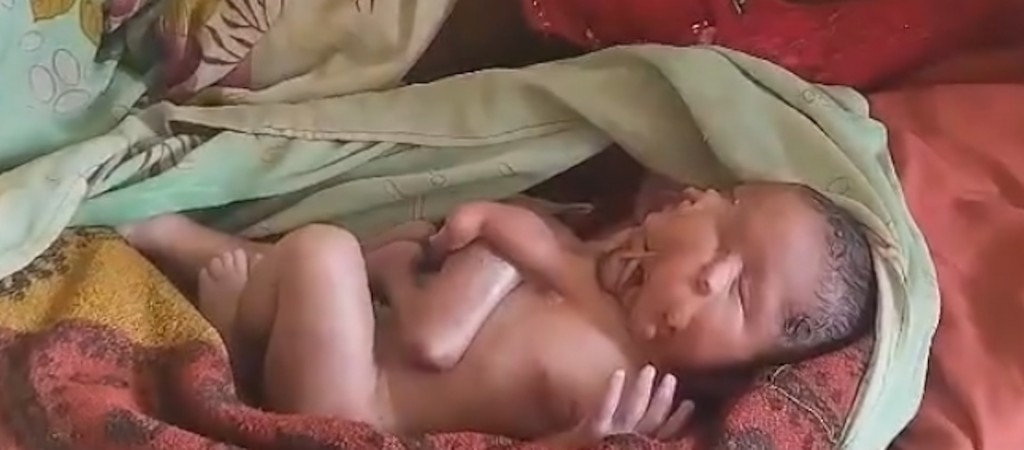 2脸4臂畸婴 2