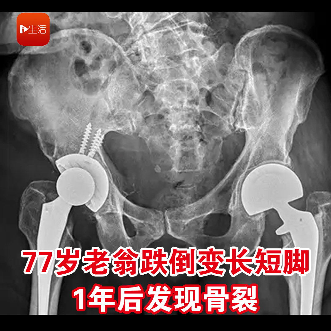 77岁老翁跌倒变长短脚 1年后发现骨裂