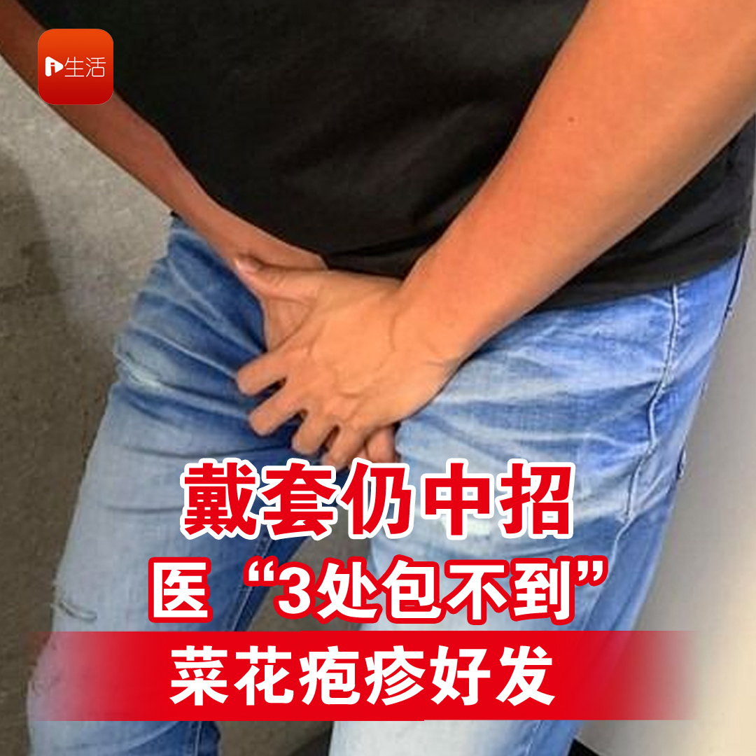 戴套仍中招 医“3处包不到” 菜花疱疹好发
