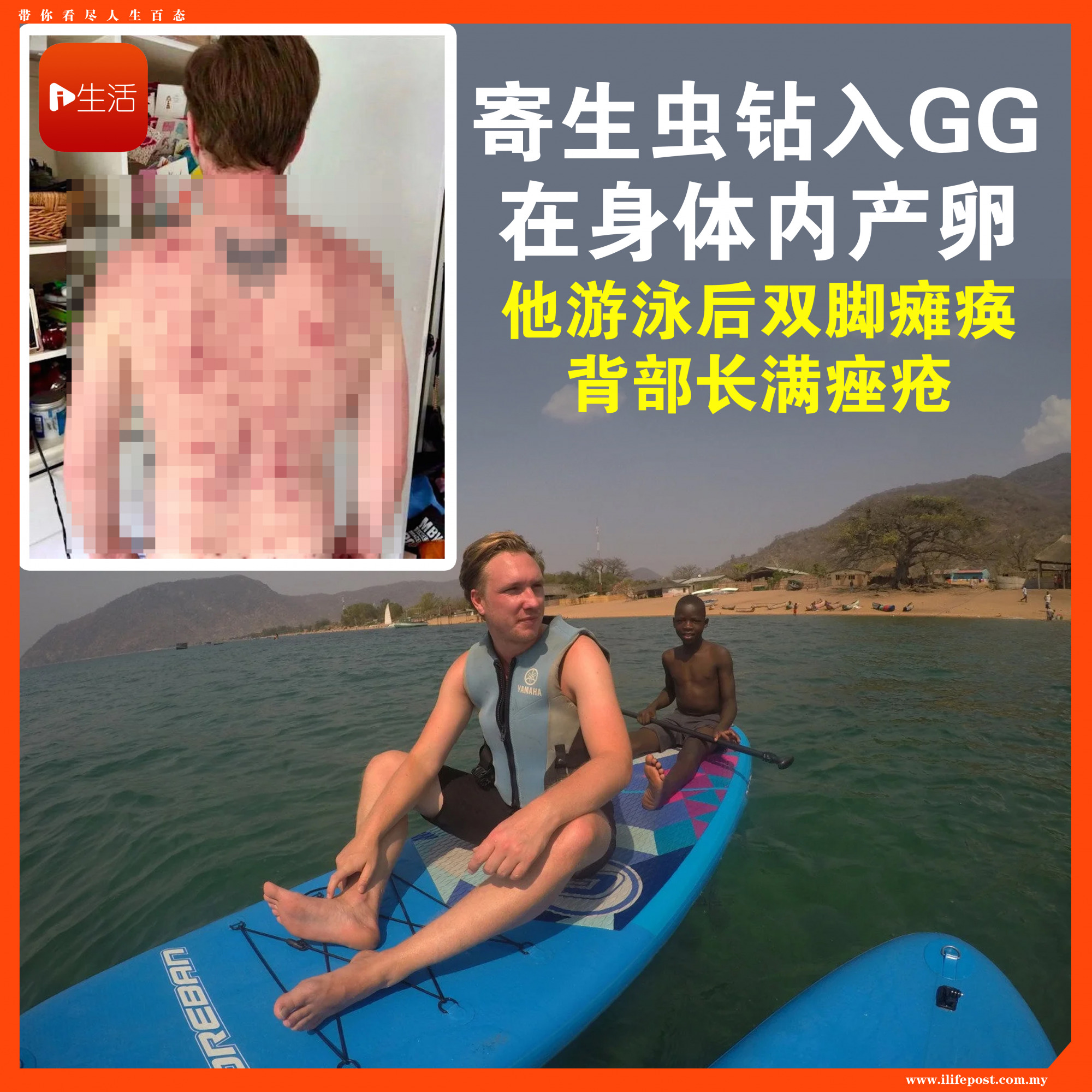 寄生虫钻入命根子“体内下蛋”…他游泳后双脚瘫痪：几乎成了废人