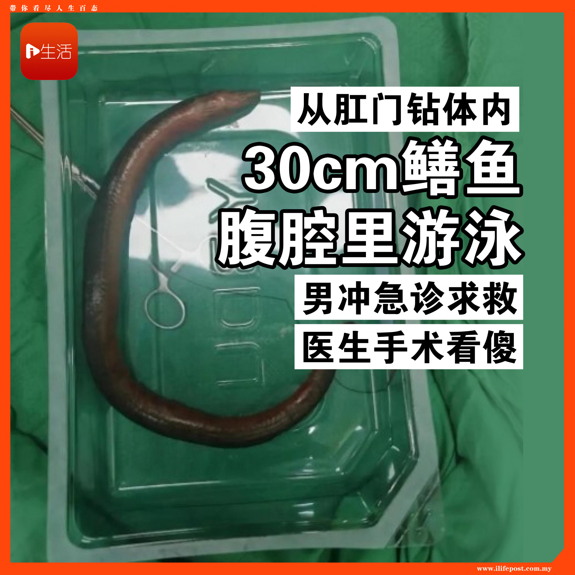 30cm鳝鱼从肛门钻体内“腹腔里游泳”　男冲急诊求救！医手术看傻