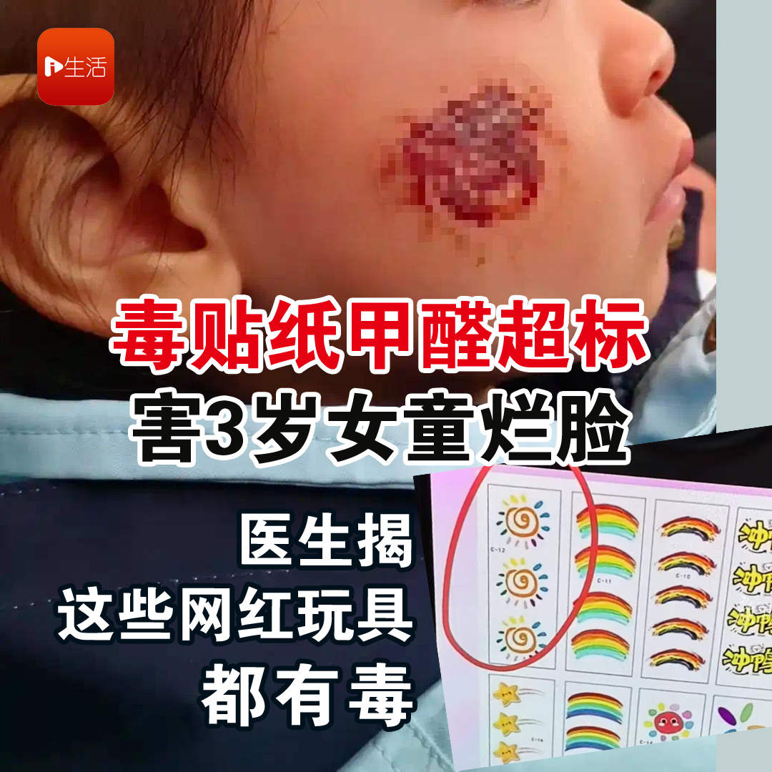 毒贴纸甲醛超标害3岁女童烂脸　医生揭这些网红玩具都有毒